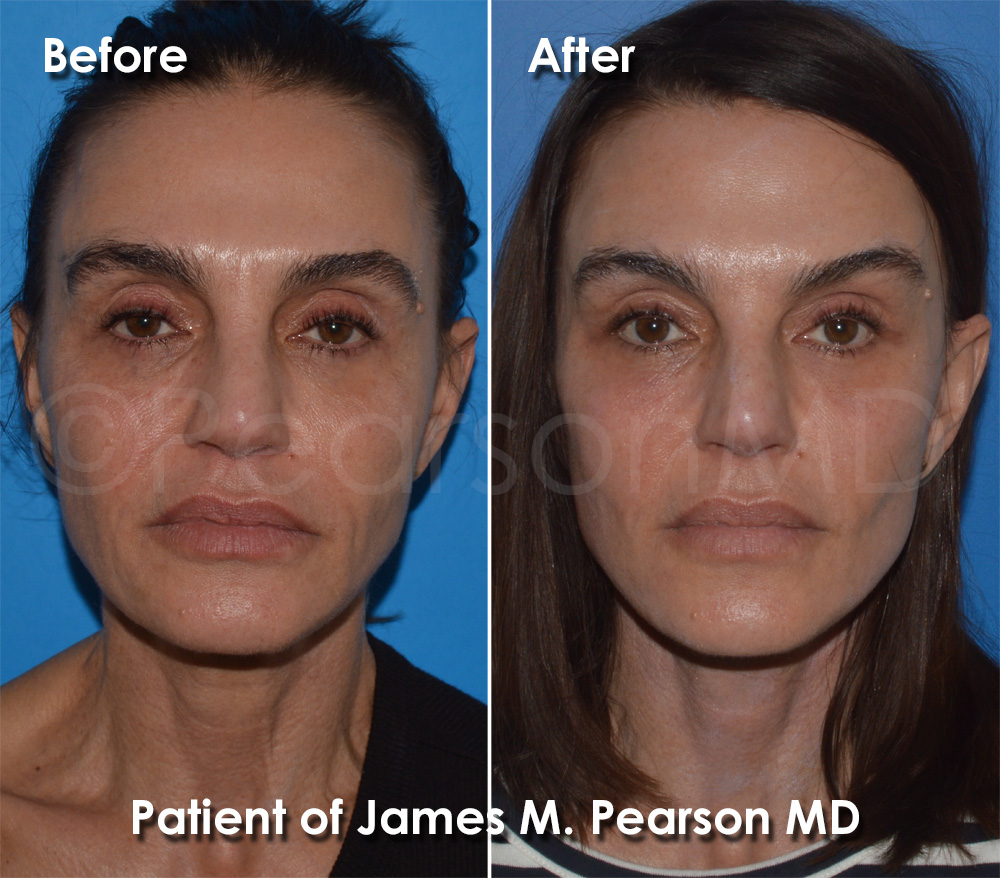 Pearson Plastic Surgery