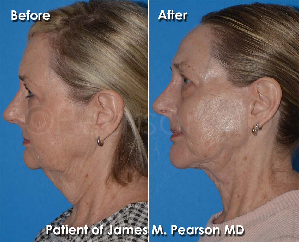 Dr. Pearson Plastic Surgeon