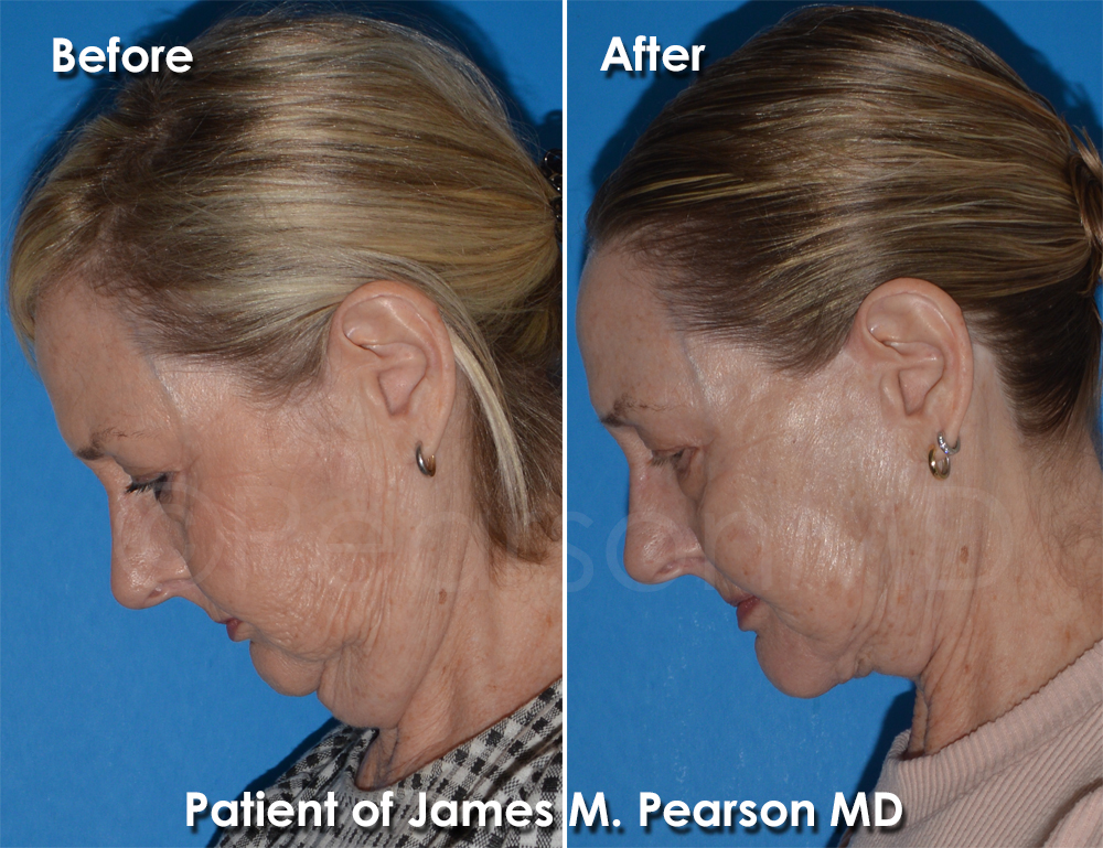 Pearson Plastic Surgery