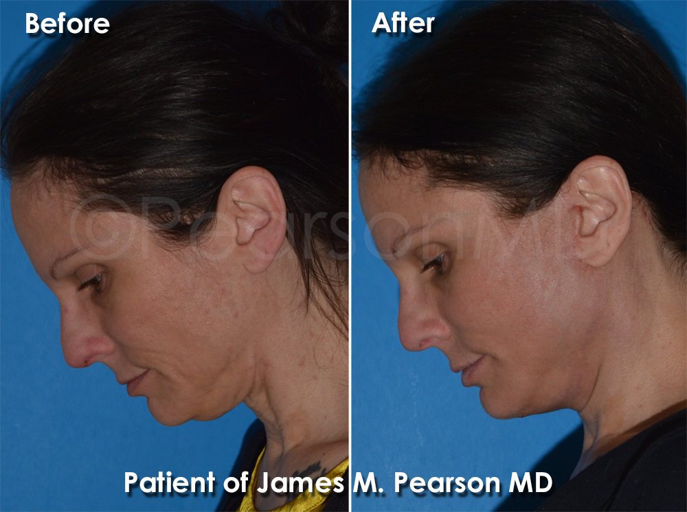 Dr. Pearson Plastic Surgeon