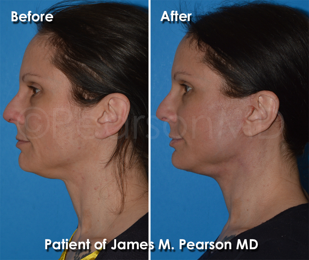 Pearson Plastic Surgery
