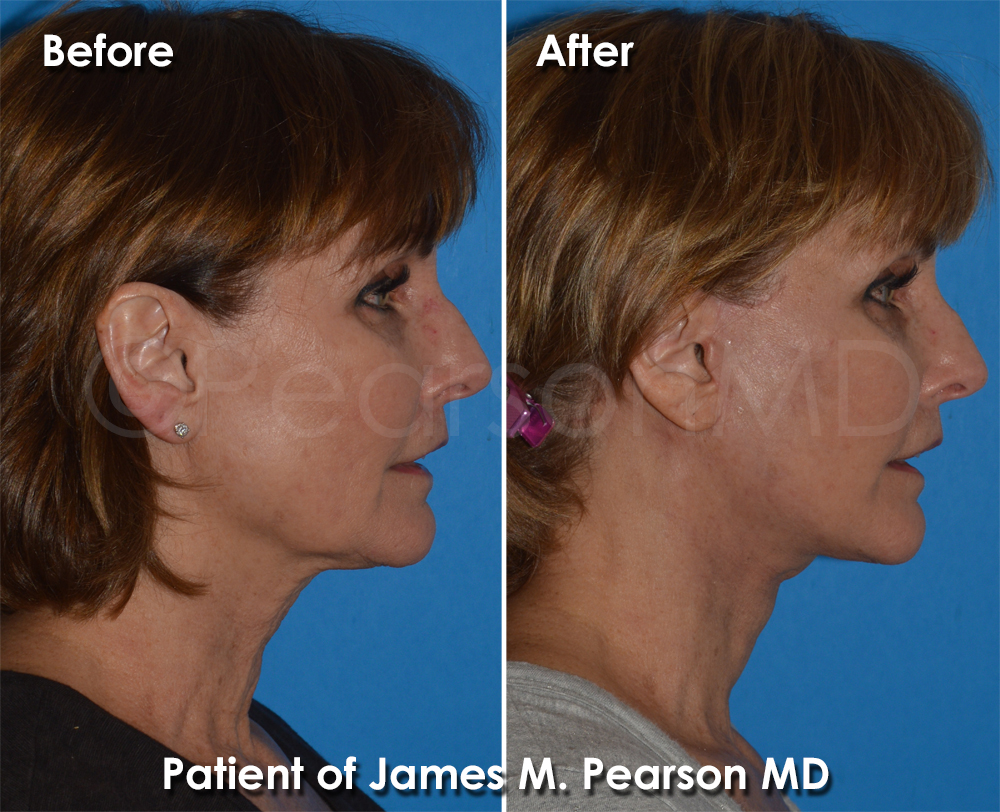 Dr. Pearson Plastic Surgeon