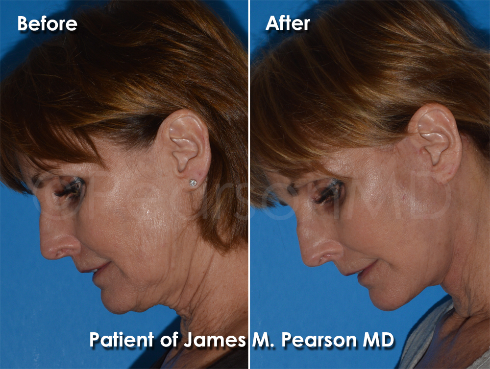 Pearson Plastic Surgery