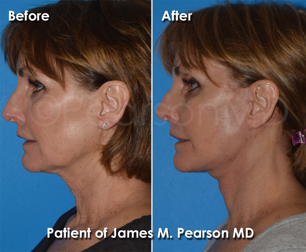 Pearson Plastic Surgery