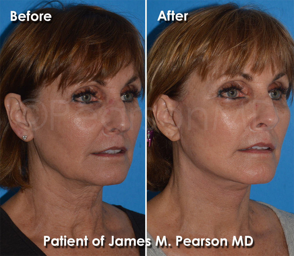 Pearson Plastic Surgery