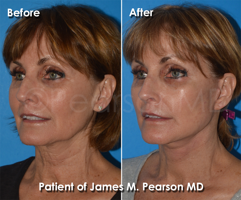 Pearson Plastic Surgery