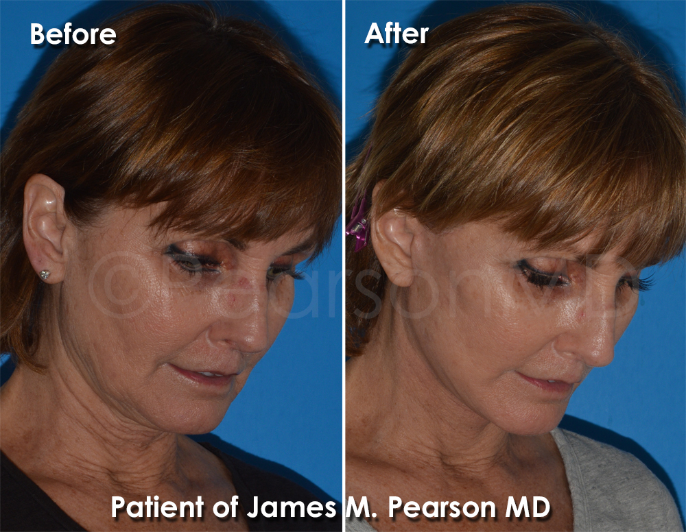 Pearson Plastic Surgery