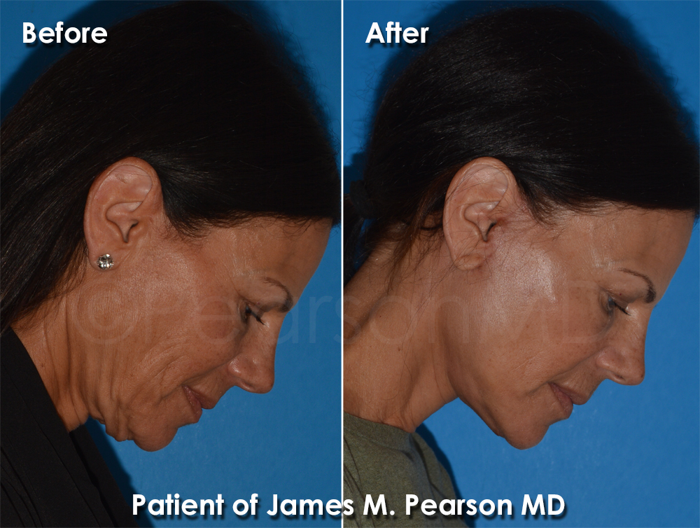 Dr. Pearson Plastic Surgeon