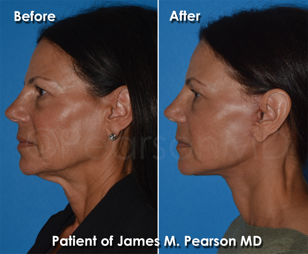Pearson Plastic Surgery