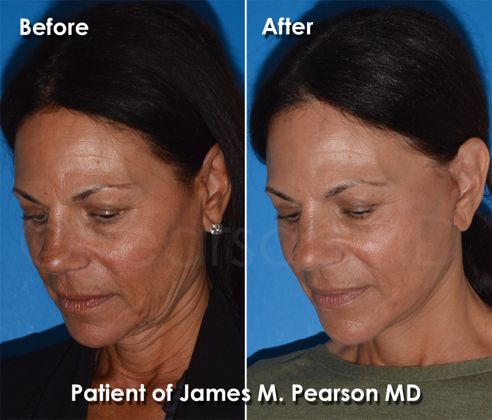 Pearson Plastic Surgery