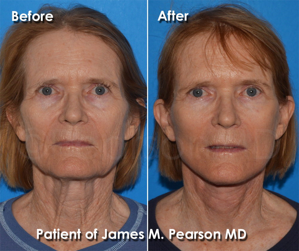Pearson Plastic Surgery