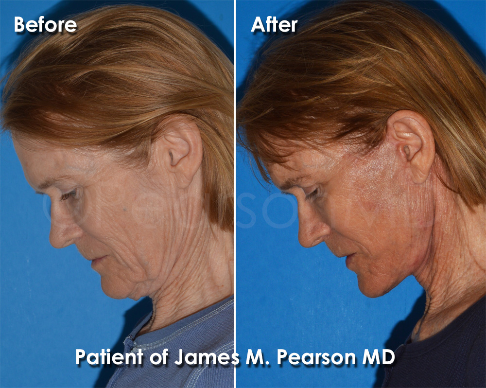 Pearson Plastic Surgery