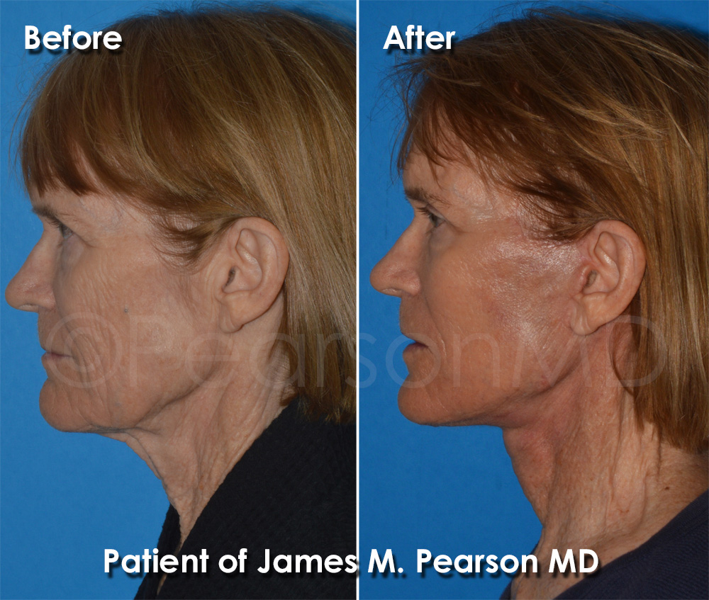 Dr. Pearson Plastic Surgeon