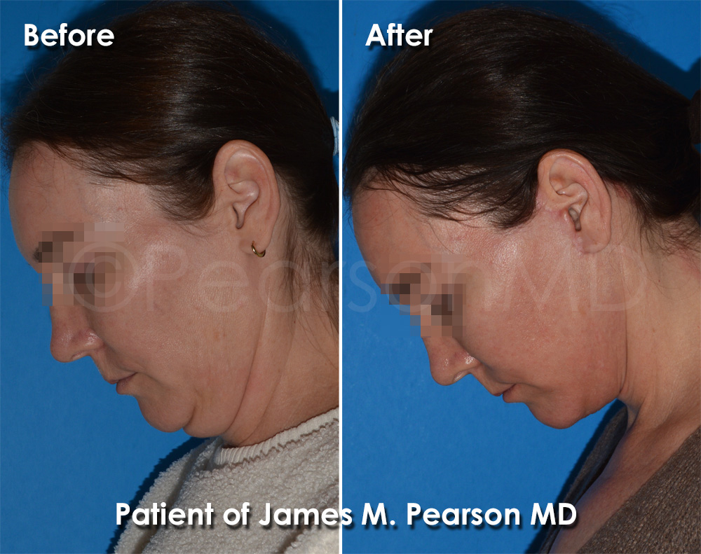 Pearson Plastic Surgery