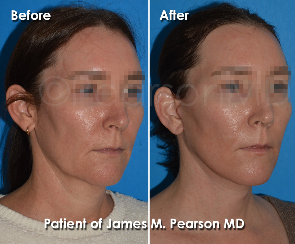 Pearson Plastic Surgery