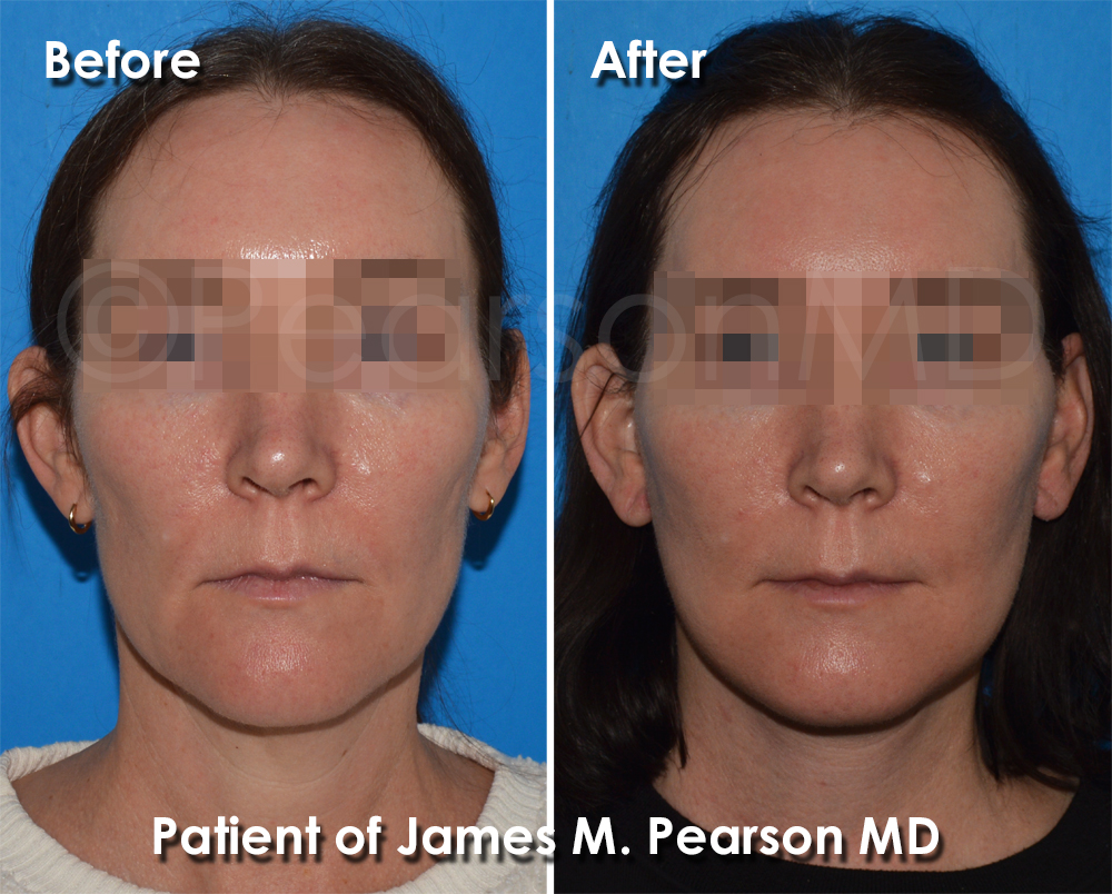 Pearson Plastic Surgery