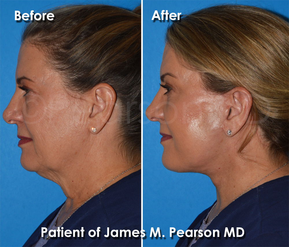 Dr. Pearson Plastic Surgeon