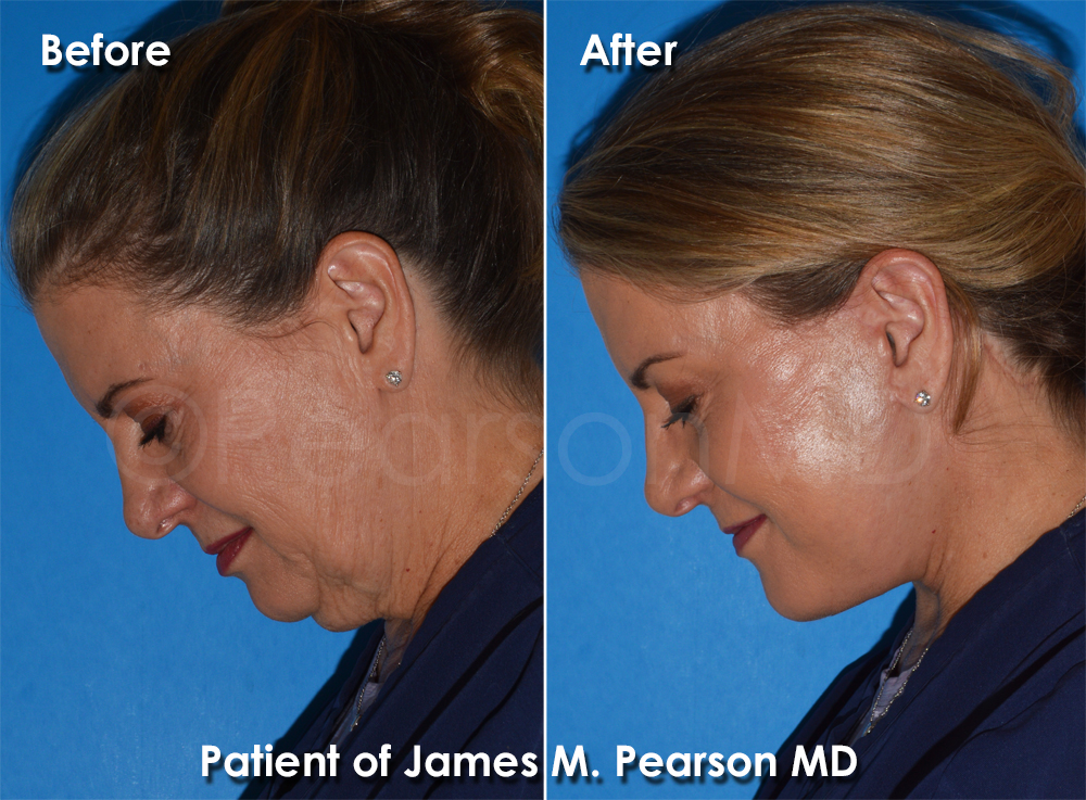 Pearson Plastic Surgery