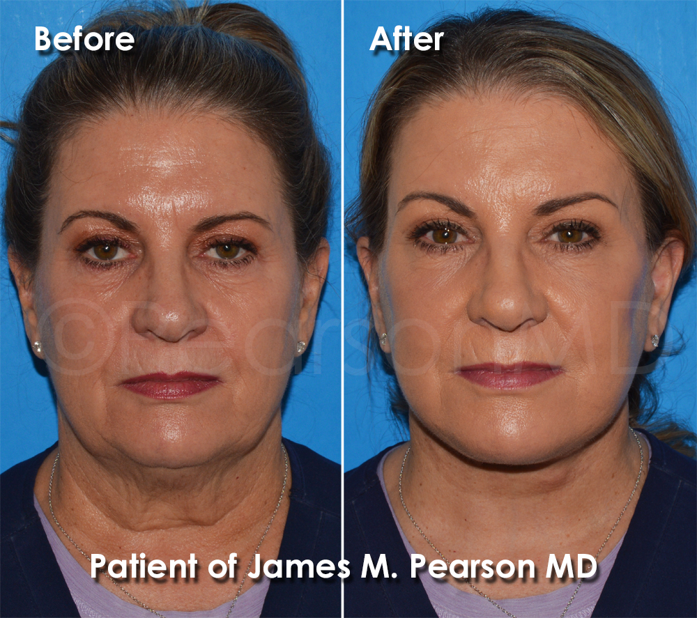 Pearson Plastic Surgery