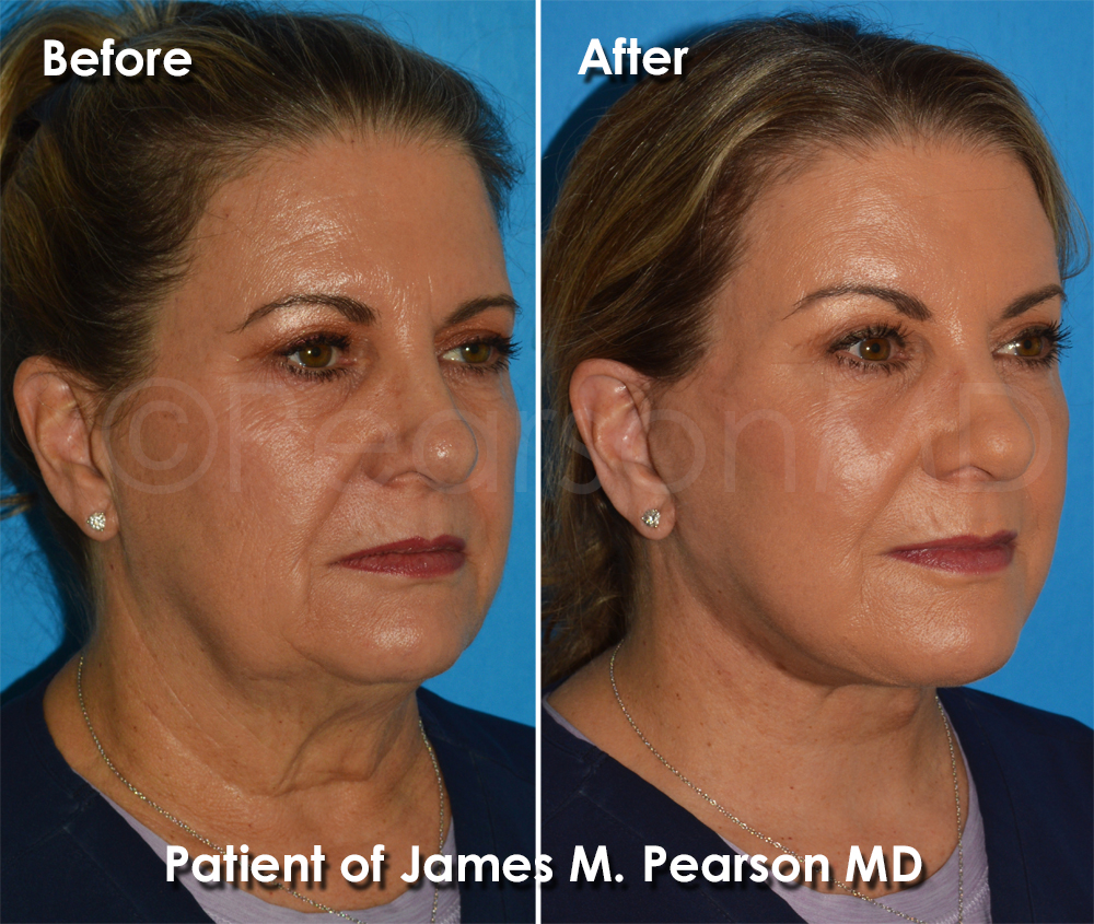 Pearson Plastic Surgery