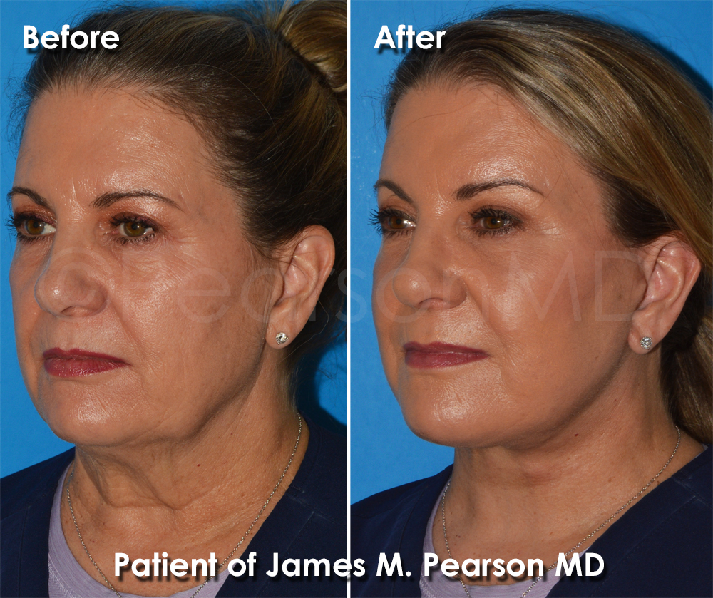 Pearson Plastic Surgery