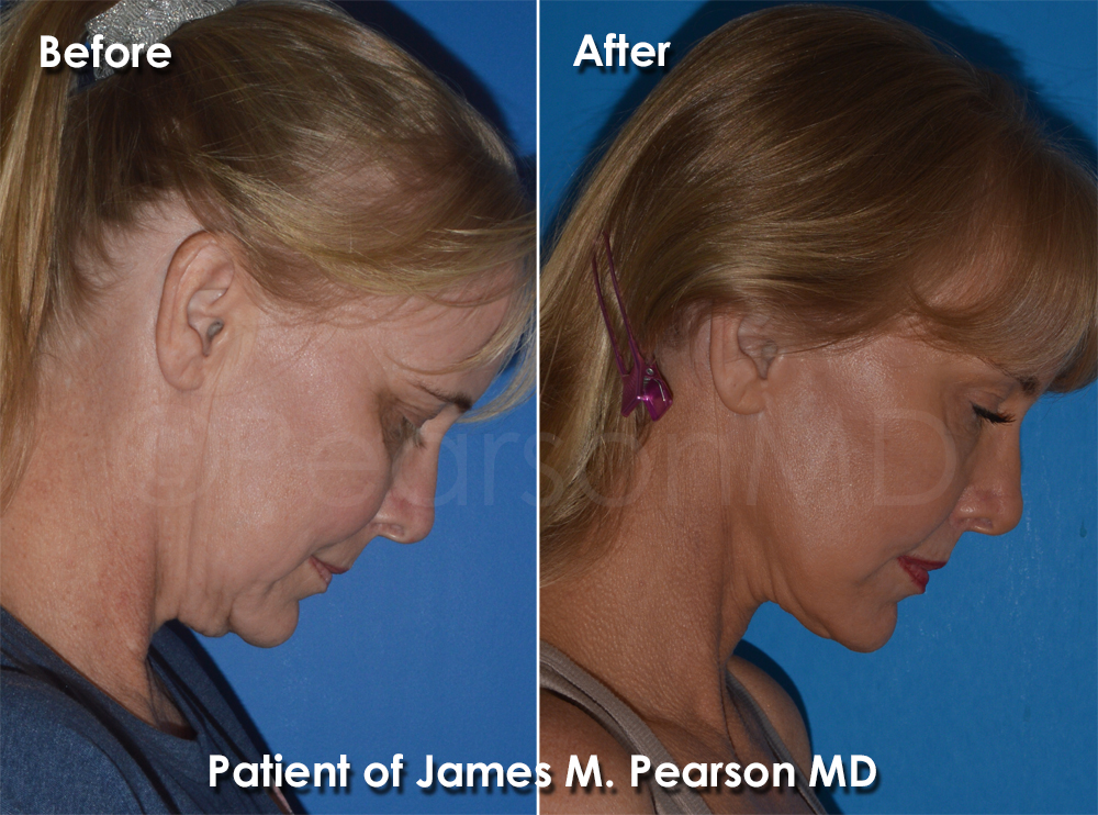 Dr. Pearson Plastic Surgeon