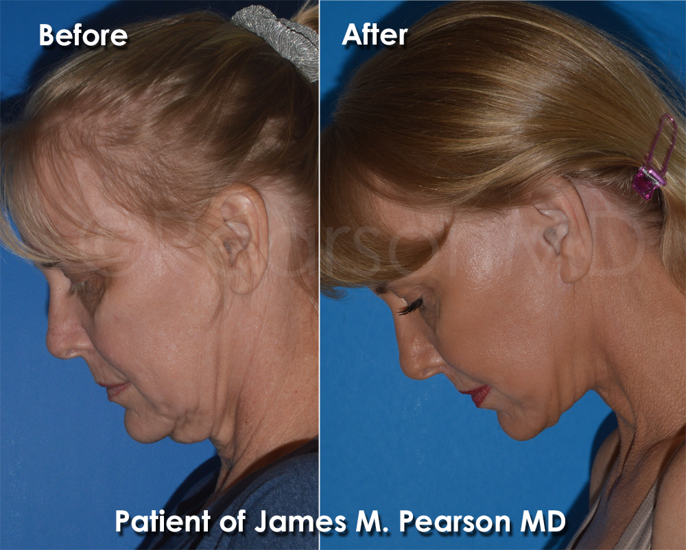 Pearson Plastic Surgery