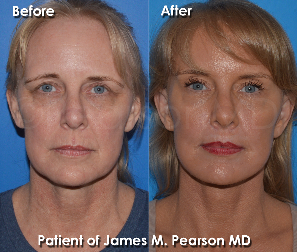 Pearson Plastic Surgery