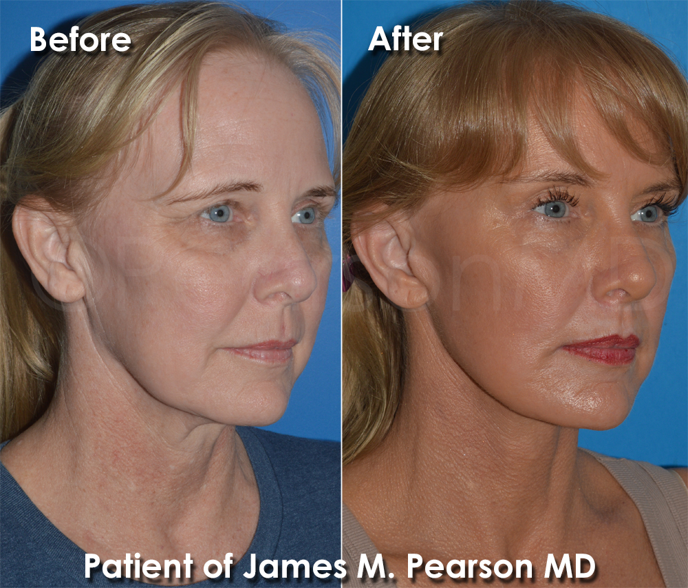 Pearson Plastic Surgery