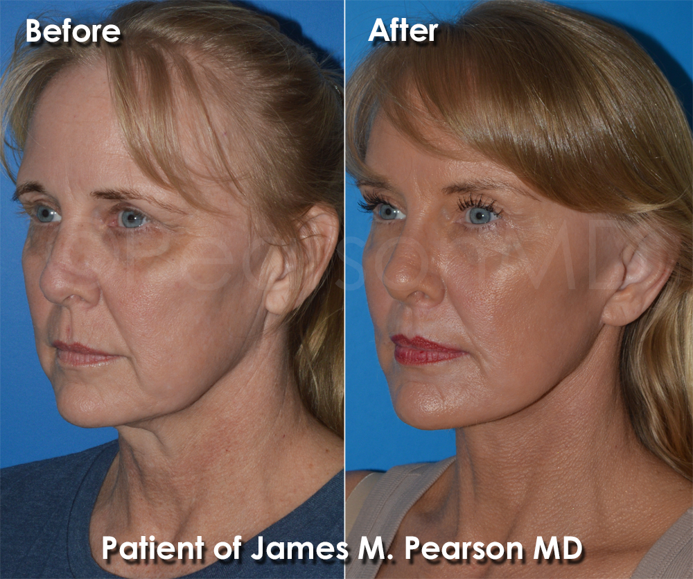 Pearson Plastic Surgery
