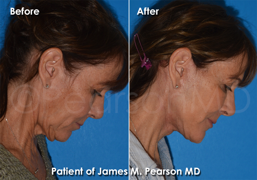 Dr. Pearson Plastic Surgeon