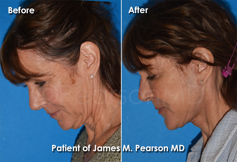Pearson Plastic Surgery