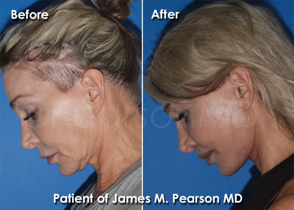 Dr. Pearson Plastic Surgeon