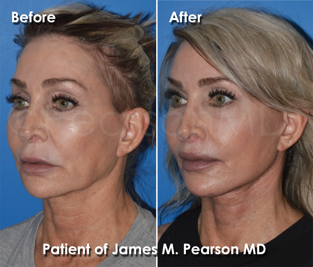 Pearson Plastic Surgery