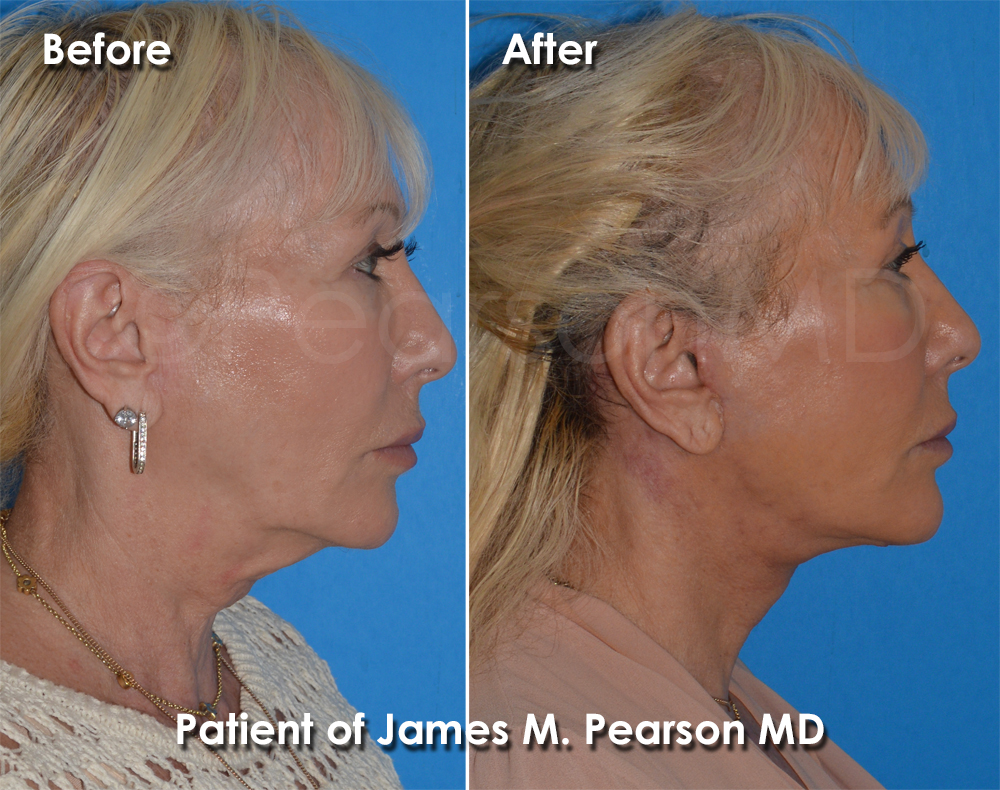Dr. Pearson Plastic Surgeon