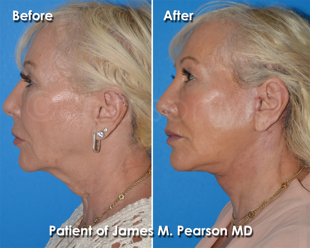 Pearson Plastic Surgery