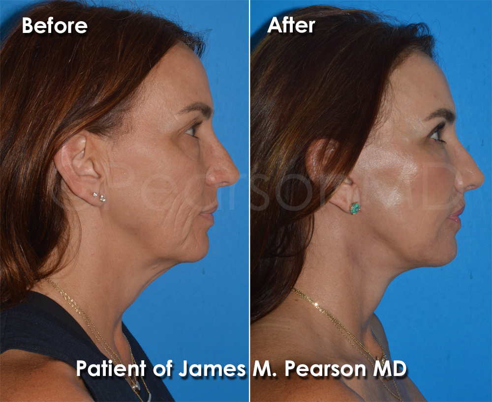 Dr. Pearson Plastic Surgeon