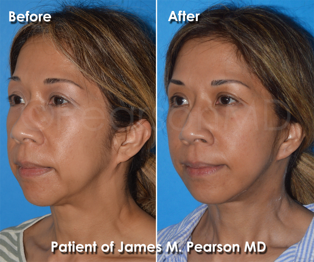 Pearson Plastic Surgery