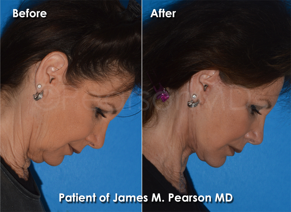 Dr. Pearson Plastic Surgeon