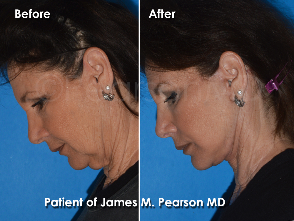 Pearson Plastic Surgery