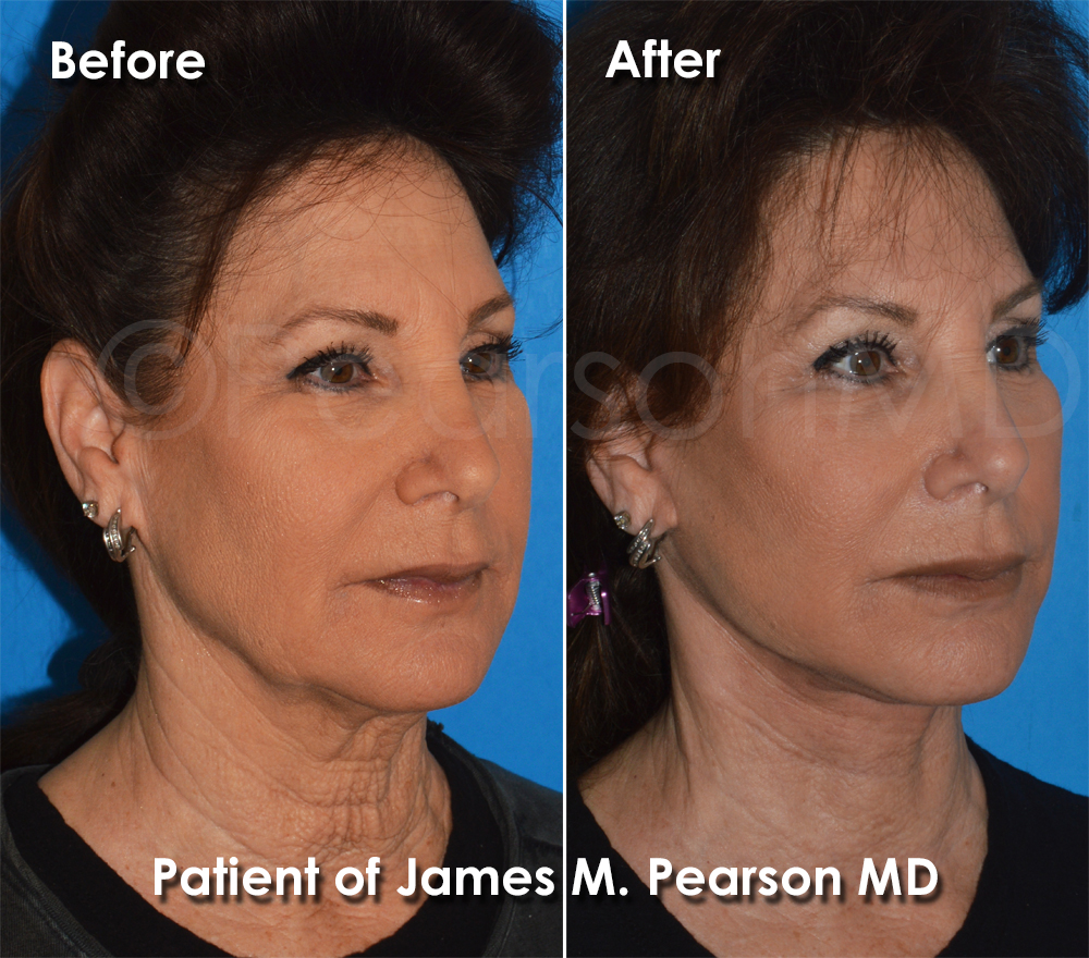 Pearson Plastic Surgery