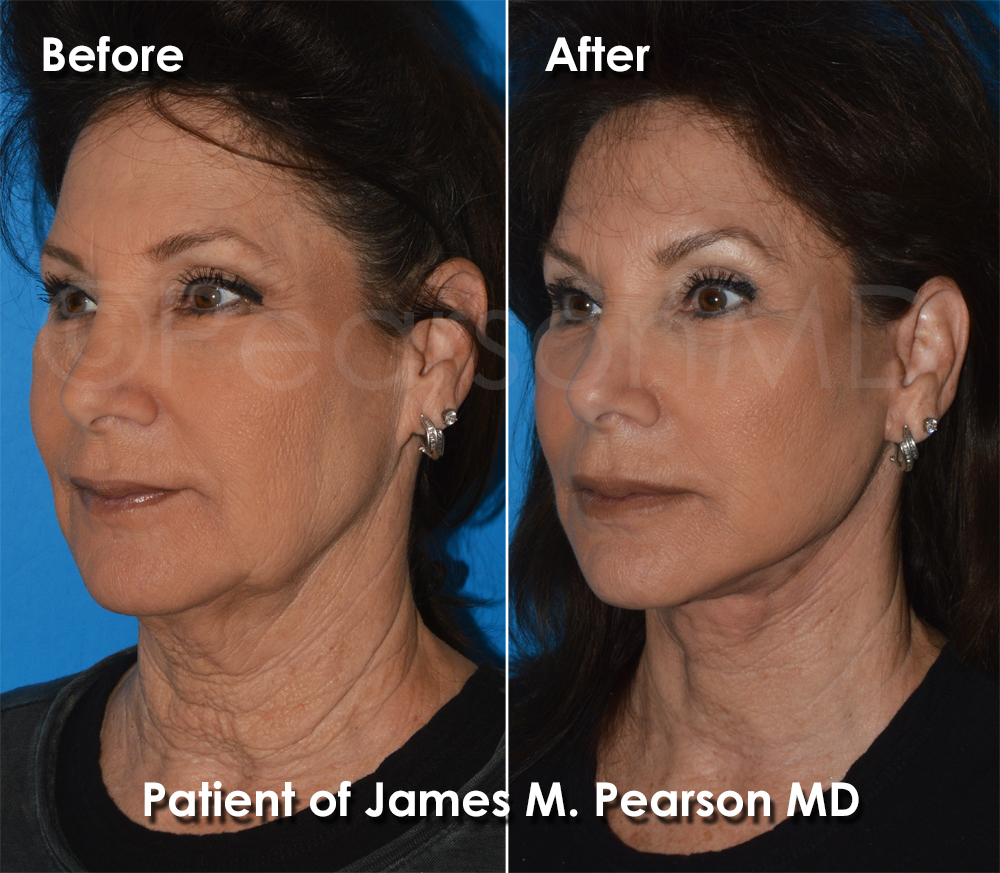 Pearson Plastic Surgery