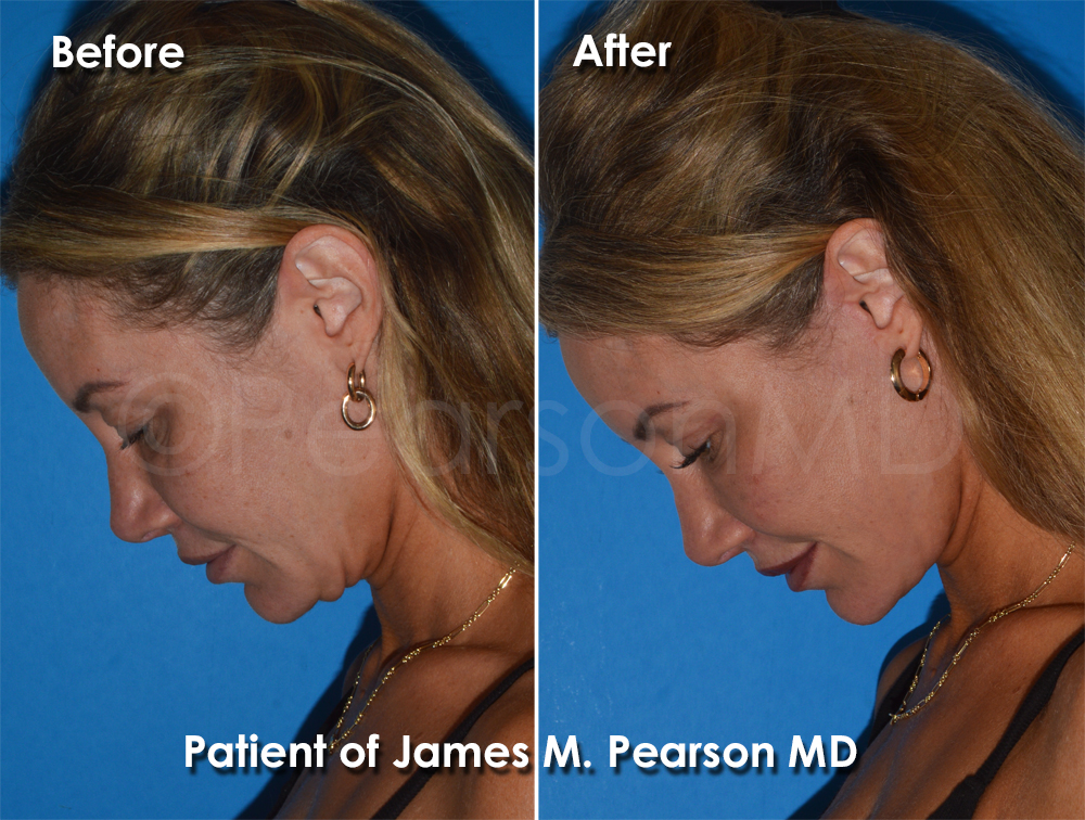 Dr. Pearson Plastic Surgeon