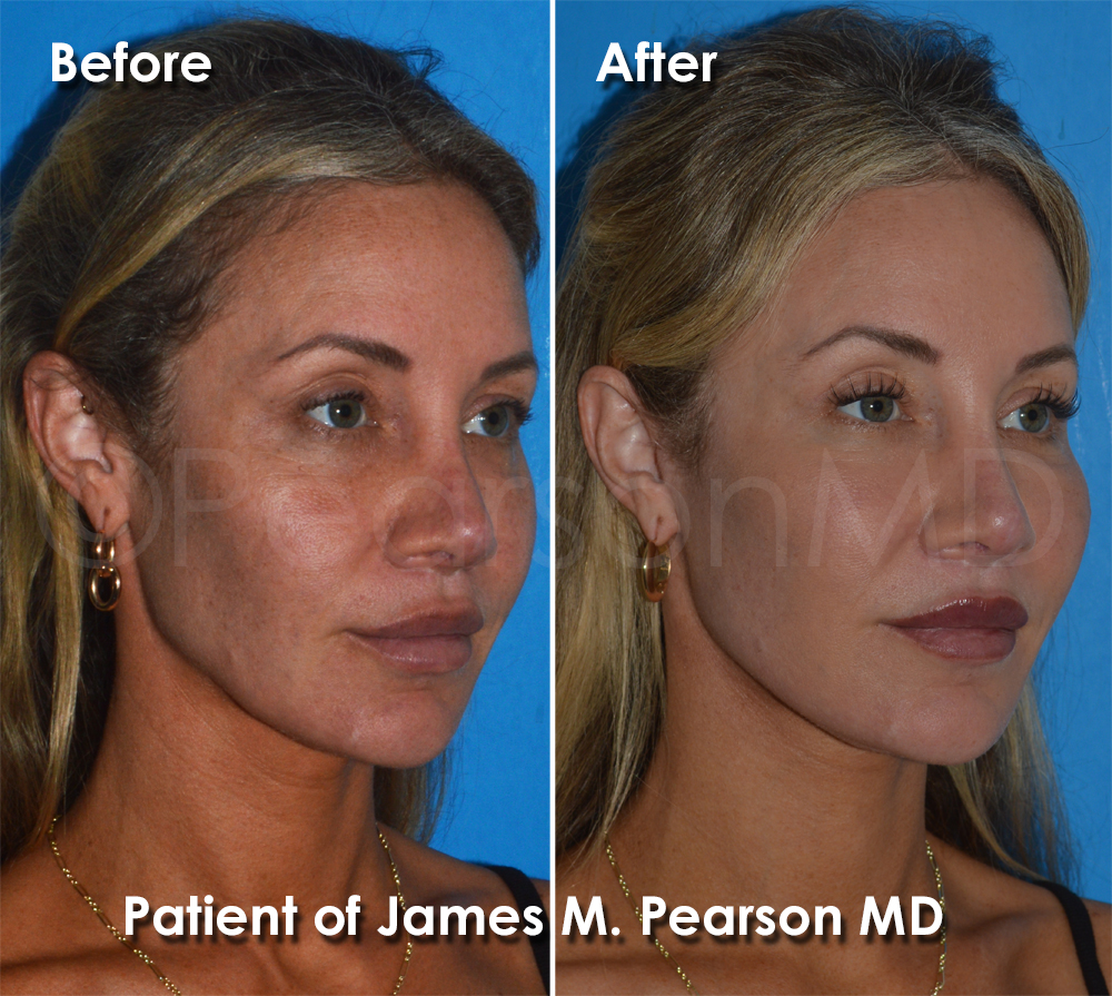 Dr. Pearson Plastic Surgeon