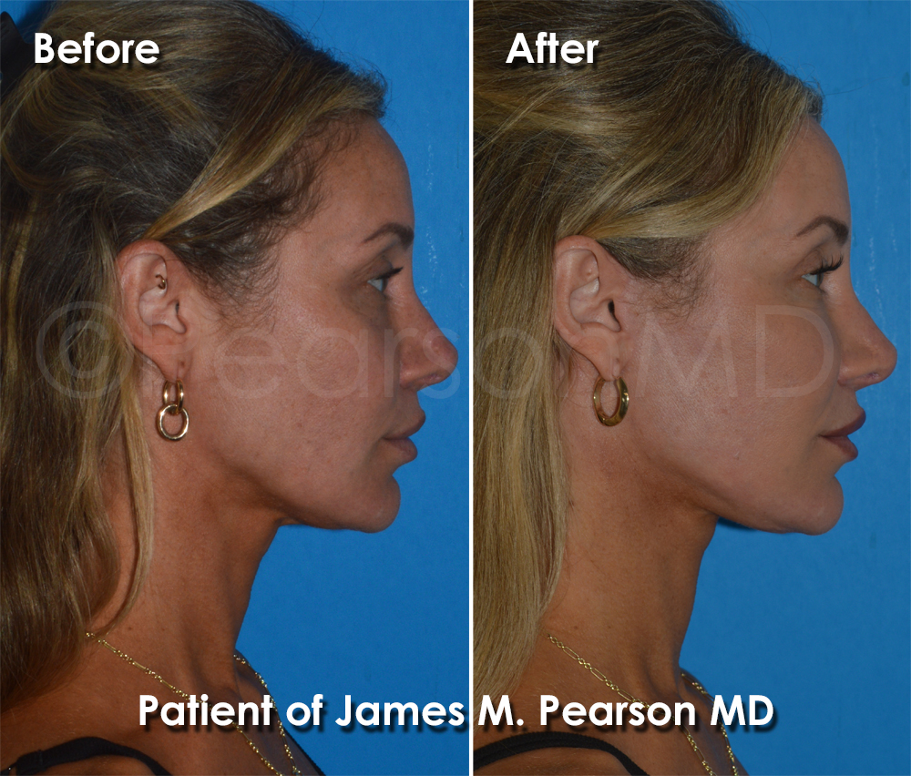 Pearson Plastic Surgery