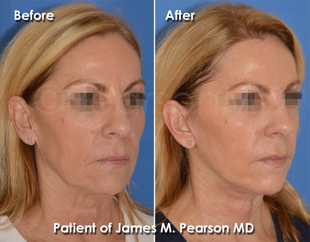 Pearson Facelift