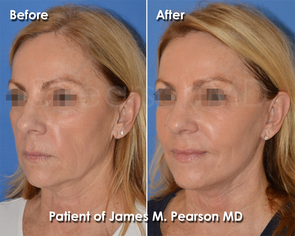Pearson Plastic Surgery