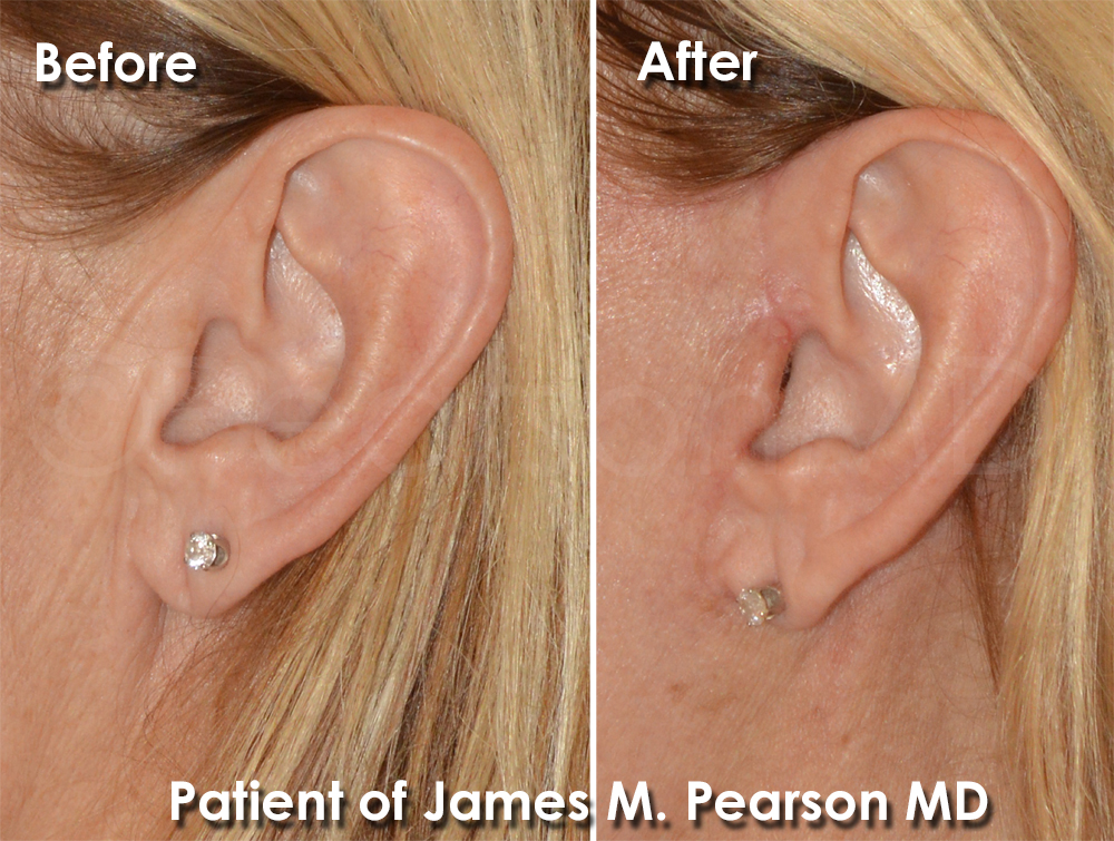 Photos Facelift Dr. James Pearson Facial Plastic Surgery Photo Facelift Incision site Dr. Pearson