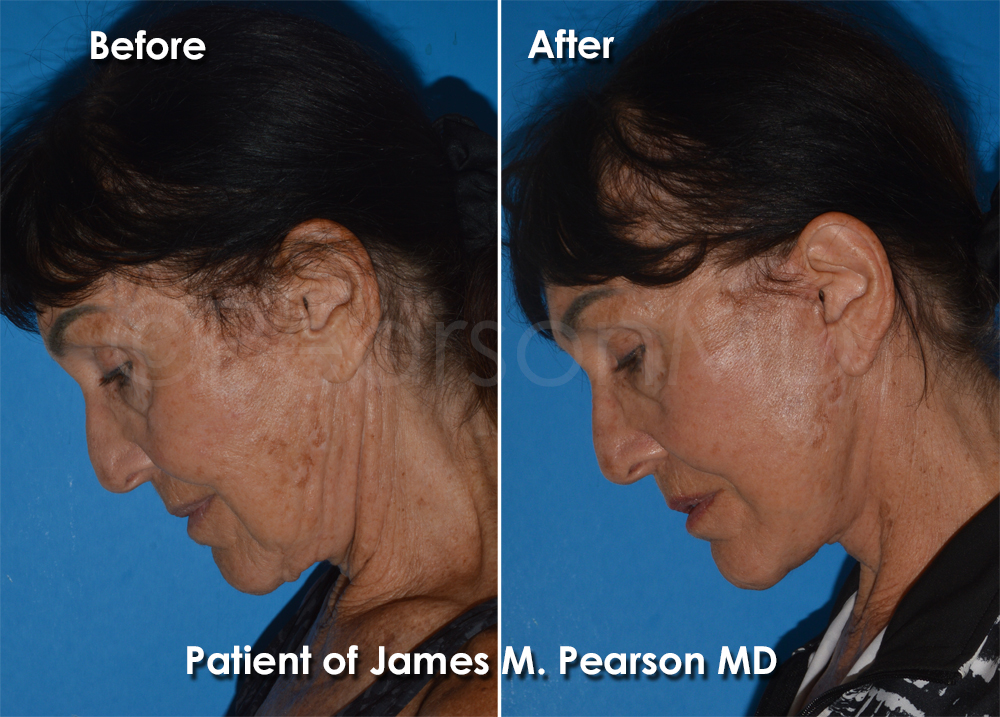 Dr. Pearson Plastic Surgeon