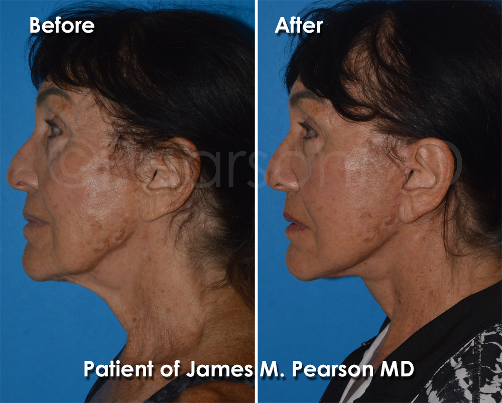 Pearson Plastic Surgery